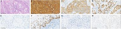 Disitamab Vedotin plus anti-PD-1 antibody show good efficacy in refractory primary urethral cancer with low HER2 expression: a case report